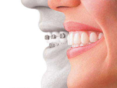 HP Dental | Invisalign reg , Oral Exams and Extractions