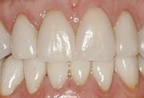 HP Dental | Teeth Whitening, Inlays amp Onlays and Air Abrasion