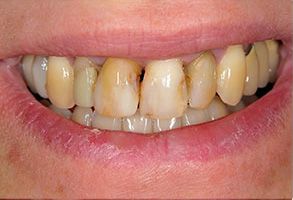 HP Dental | Ceramic Crowns, Inlays  amp  Onlays and Preventative Program