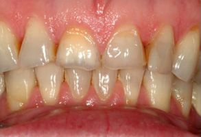 HP Dental | Teeth Whitening, Digital Impressions and Invisalign reg