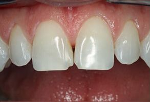 HP Dental | Root Canals, Air Abrasion and Dental Fillings